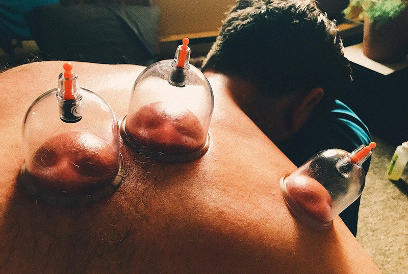 Cupping Therapy Benefits: Explore To Restore Whole Body Wellness